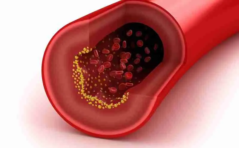 Free Testosterone Inversely Related to Carotid Atherosclerosis