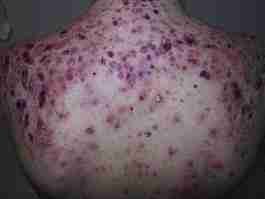 Effects of anabolic steroids on the skin 