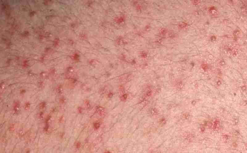 Effects of anabolic steroids on the skin
