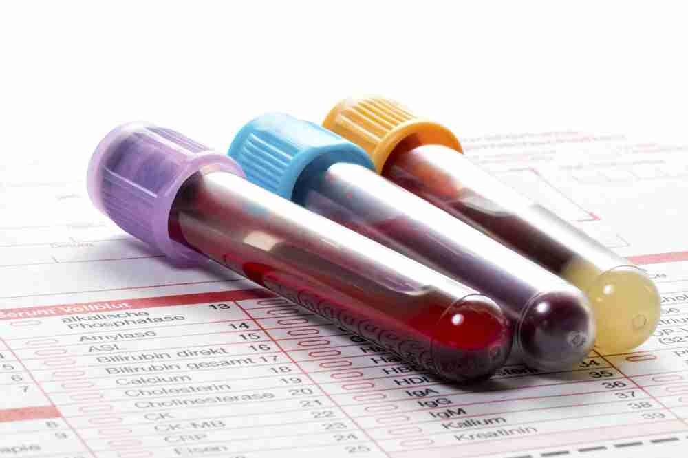 Bloodwork for Steroid Users: Obtaining Testing to Safely Monitor Cycles