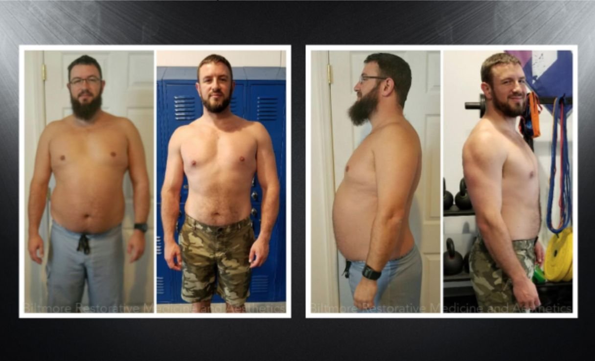 Testosterone Replacement Therapy Before and After
